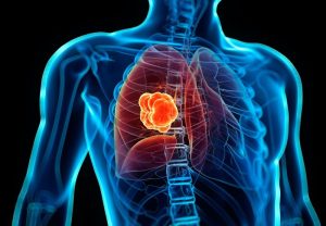 انواع بیماری‌های COPD و درمان آن