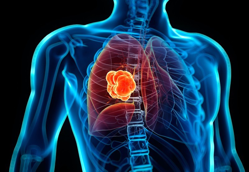 انواع بیماری‌های COPD و درمان آن