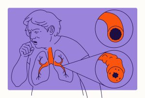 انواع بیماری‌های COPD و درمان آن
