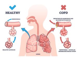 انواع بیماری‌های COPD و درمان آن